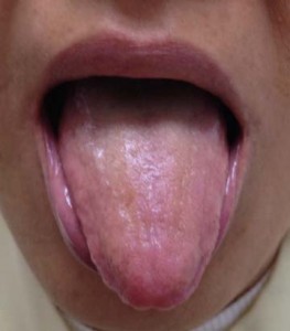 Tongue Pain