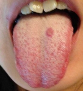 Tongue Pain