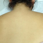 Chronic Shoulder Pain of A Gymnast