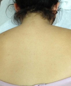 Chronic Shoulder Pain of A Gymnast
